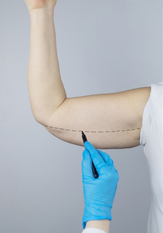 Enhance your arms with a top Arm Lift Surgery Florida surgeon in Coral Springs. Safe, effective brachioplasty for a firmer, sculpted look.