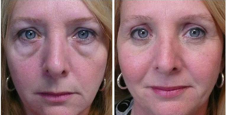 Consult a Blepharoplasty Surgeon in Coral Springs for safe, effective eyelid surgery that restores eye appearance and enhances your confidence.