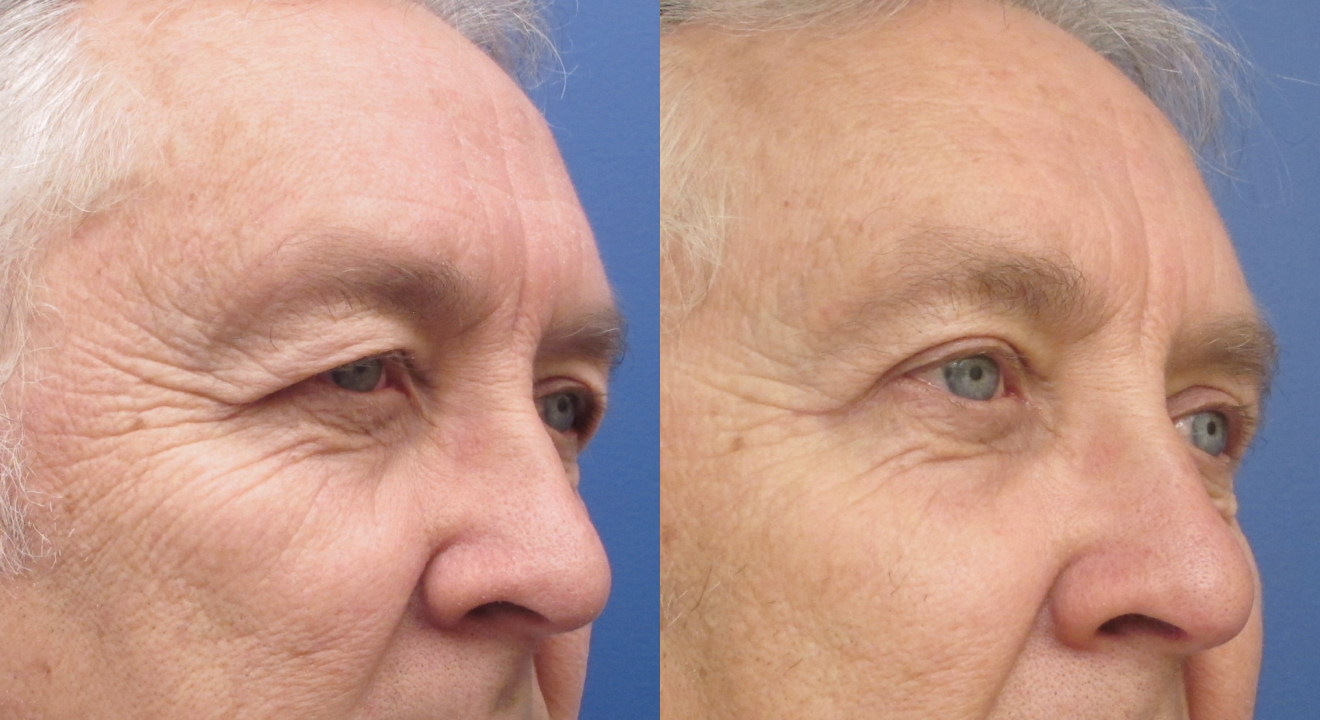Consult a Blepharoplasty Surgeon in Coral Springs for safe, effective eyelid surgery that restores eye appearance and enhances your confidence.