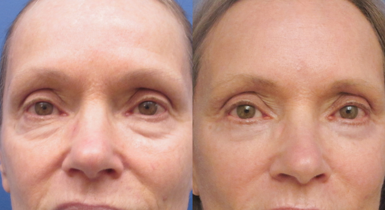 Consult a Blepharoplasty Surgeon in Coral Springs for safe, effective eyelid surgery that restores eye appearance and enhances your confidence.