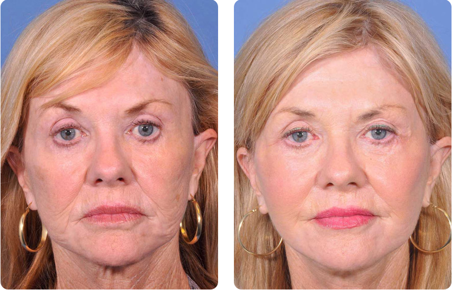 Looking for Facial Rejuvenation Surgery FL Get details on procedures benefits recovery time and expert tips for achieving a natural youthful look
