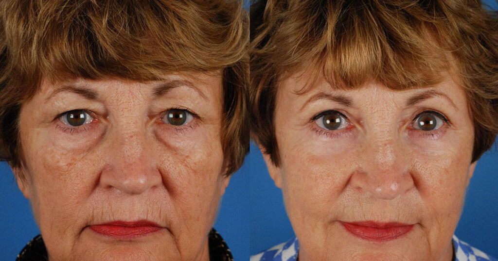 Looking for Eyelid Surgery Coral Springs Learn about benefits treatment options results and recovery for a smoother younger eye appearance today.