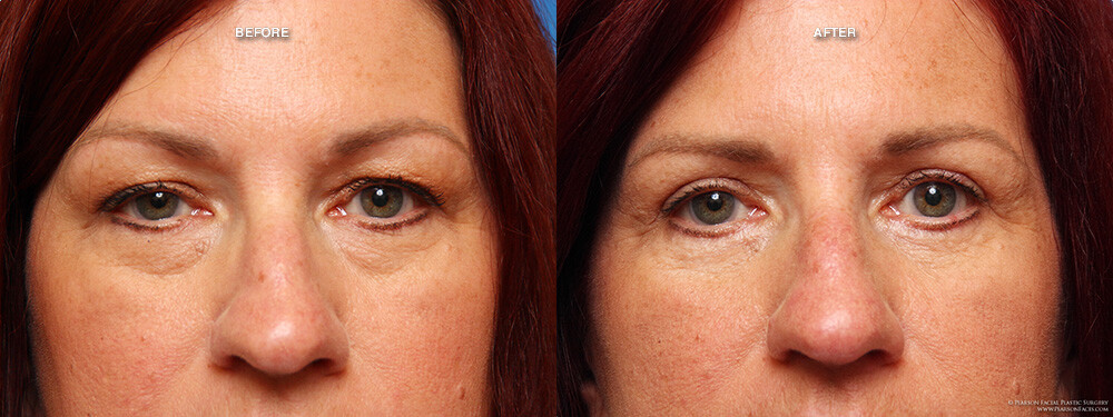 Looking for Eyelid Surgery Coral Springs Learn about benefits treatment options results and recovery for a smoother younger eye appearance today.