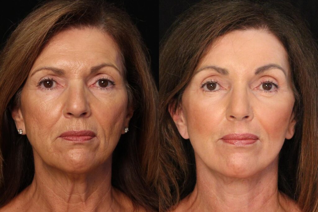 Explore our complete guide to Facelift Surgery in Florida covering treatment options, recovery time, benefits, and lasting results.