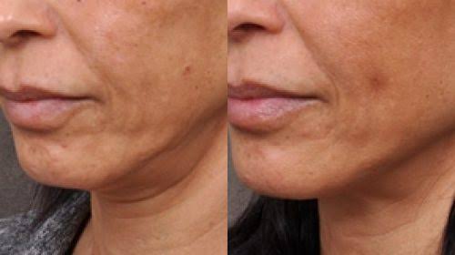 Explore our complete guide to Facelift Surgery in Florida covering treatment options, recovery time, benefits, and lasting results.