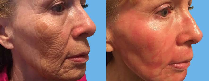 Explore our complete guide to Facelift Surgery in Florida covering treatment options, recovery time, benefits, and lasting results. Explore our complete guide to Facelift Surgery in Florida covering treatment options, recovery time, benefits, and lasting results.
