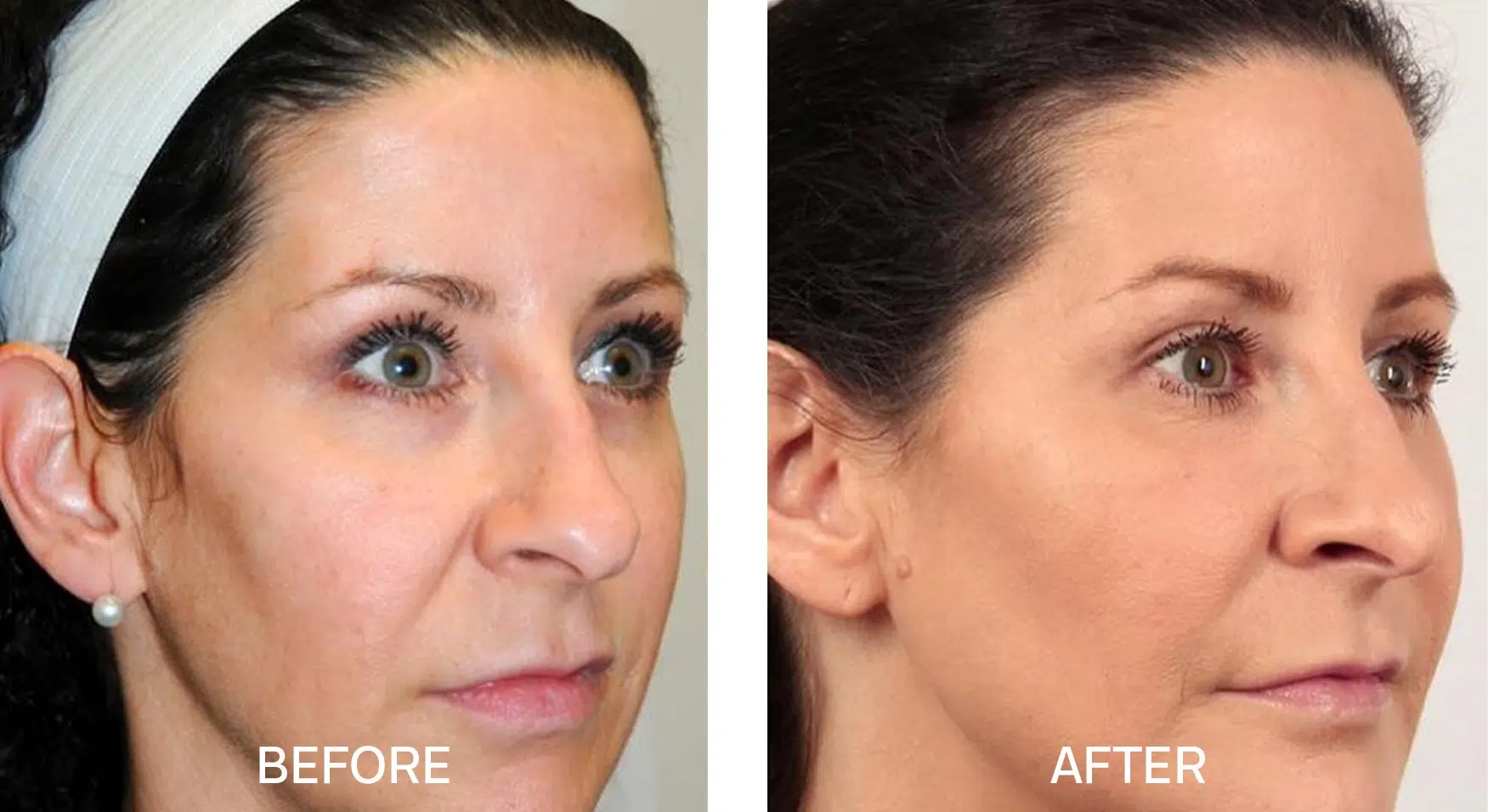 Choose a trusted Facial Rejuvenation Surgeon in Florida with confidence. Compare experience, reviews, credentials, and results today.