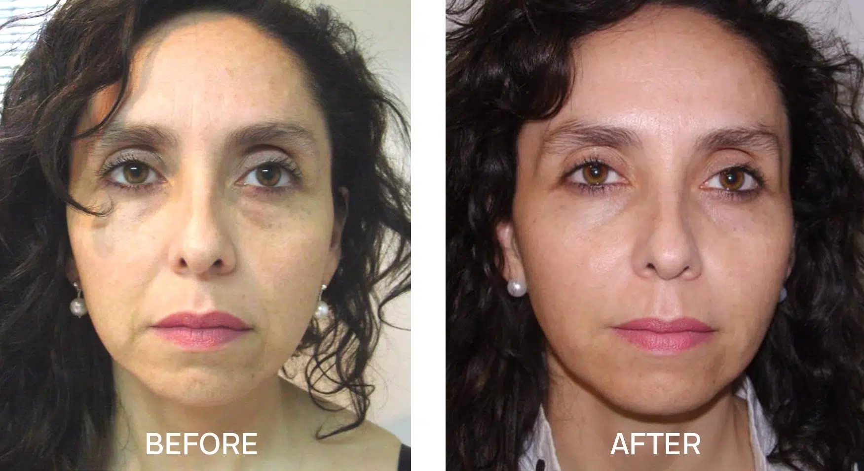 Choose a trusted Facial Rejuvenation Surgeon in Florida with confidence. Compare experience, reviews, credentials, and results today.