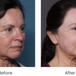 Choose a trusted Facial Rejuvenation Surgeon in Florida with confidence. Compare experience, reviews, credentials, and results today.