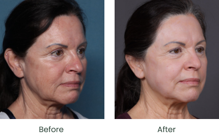Choose a trusted Facial Rejuvenation Surgeon in Florida with confidence. Compare experience, reviews, credentials, and results today. Choose a trusted Facial Rejuvenation Surgeon in Florida with confidence. Compare experience, reviews, credentials, and results today.