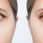 Who Is a Good Candidate for Blepharoplasty Coral Springs, FL?