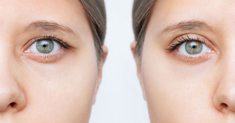 Who Is a Good Candidate for Blepharoplasty Coral Springs, FL?