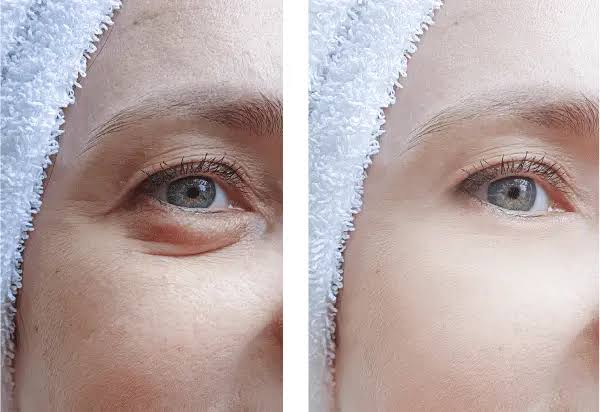 Blepharoplasty Coral Springs, FL Recovery Timeline and Tips