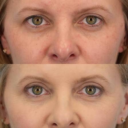 Blepharoplasty Coral Springs, FL Recovery Timeline and Tips