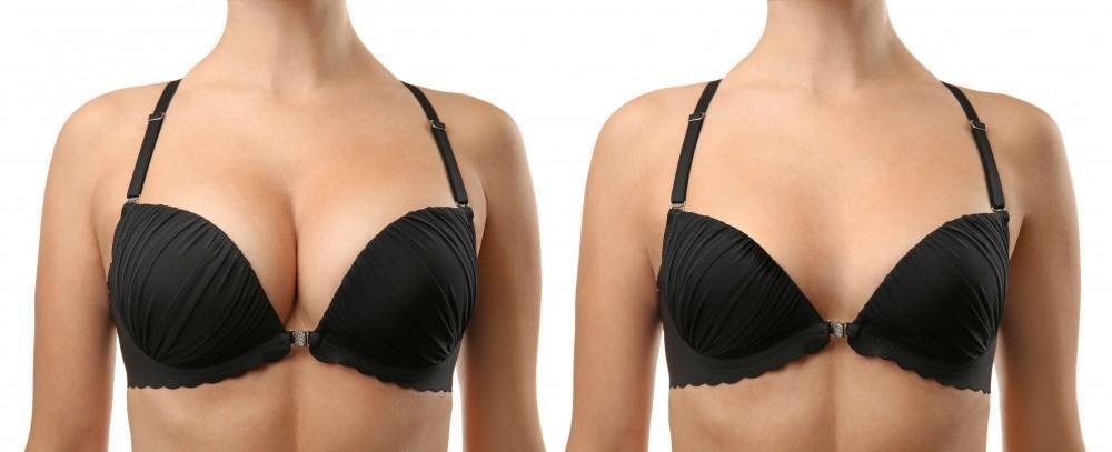 Explore the benefits of Breast Reduction Mammoplasty, including improved comfort, easier movement, and a more balanced breast appearance.