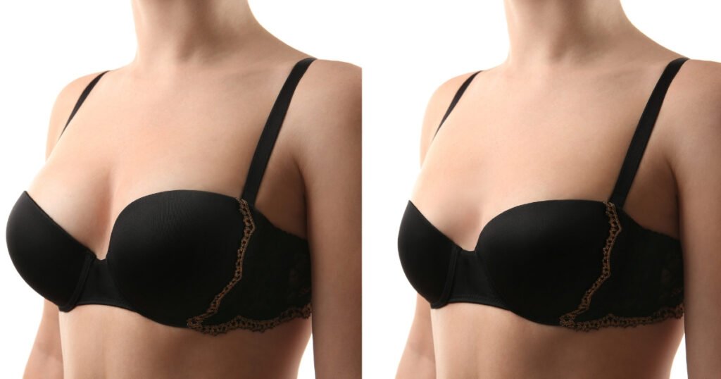 Explore the benefits of Breast Reduction Mammoplasty, including improved comfort, easier movement, and a more balanced breast appearance.