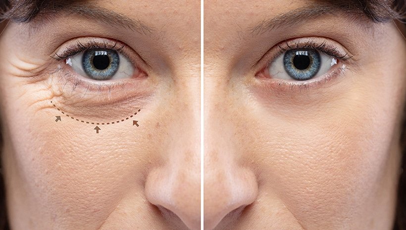 Explore Eyelid Surgery Coral Springs FL, from treatment options and benefits to recovery tips and important questions to ask before your procedure. Explore Eyelid Surgery Coral Springs FL, from treatment options and benefits to recovery tips and important questions to ask before your procedure.