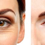 Explore Eyelid Surgery Coral Springs FL, from treatment options and benefits to recovery tips and important questions to ask before your procedure.