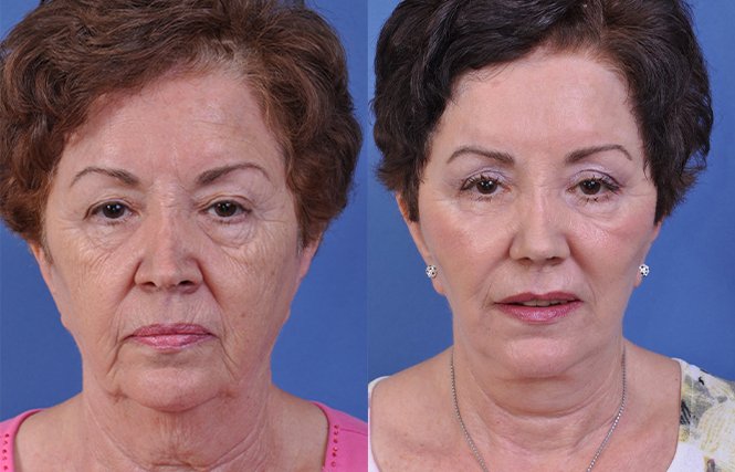 Learn about Facial Surgery options in Florida, including common procedures, potential benefits, and what to consider before choosing treatment.