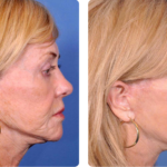 Learn about Facial Surgery options in Florida, including common procedures, potential benefits, and what to consider before choosing treatment.