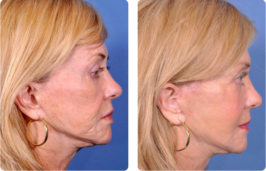 Learn about Facial Surgery options in Florida, including common procedures, potential benefits, and what to consider before choosing treatment. Learn about Facial Surgery options in Florida, including common procedures, potential benefits, and what to consider before choosing treatment.