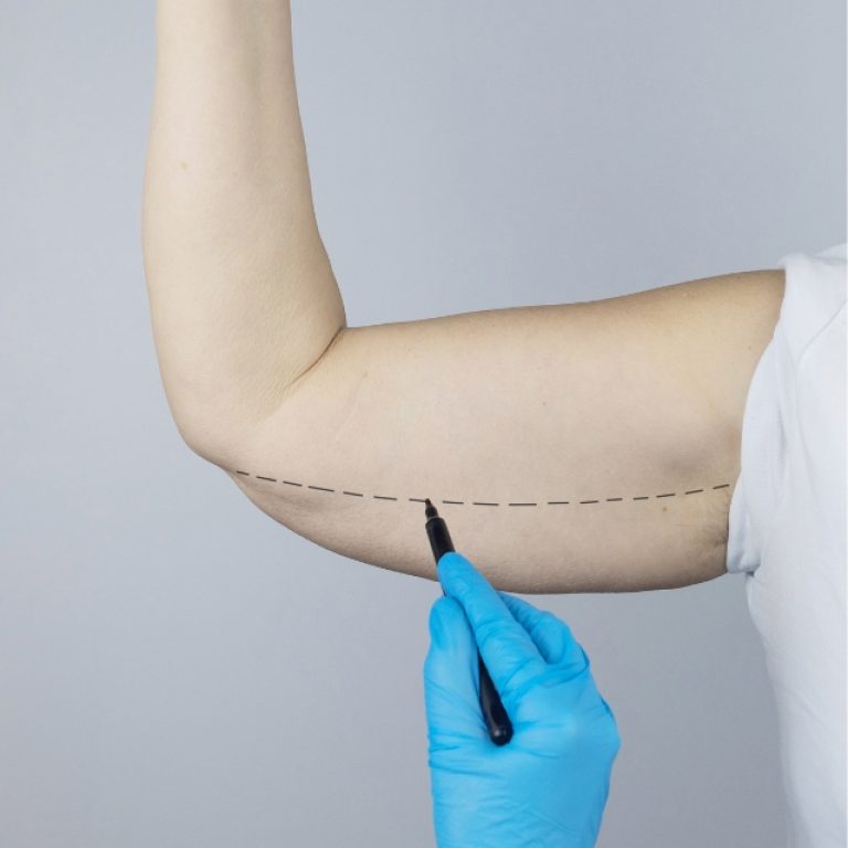 Enhance your arms with a top Arm Lift Surgery Florida surgeon in Coral Springs. Safe, effective brachioplasty for a firmer, sculpted look.