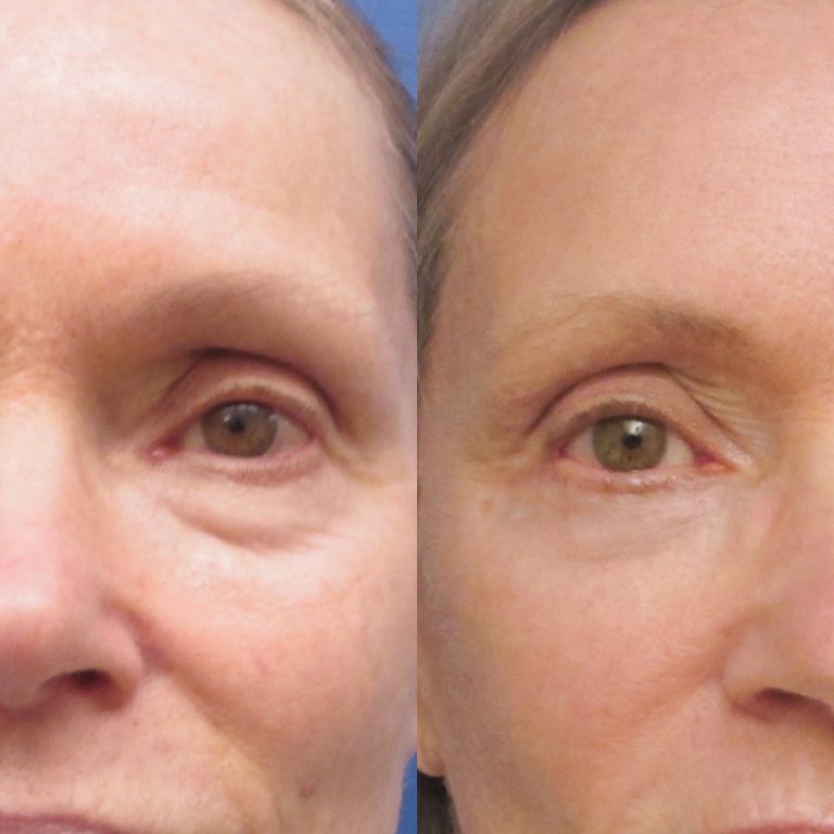 Consult a Blepharoplasty Surgeon in Coral Springs for safe, effective eyelid surgery that restores eye appearance and enhances your confidence.
