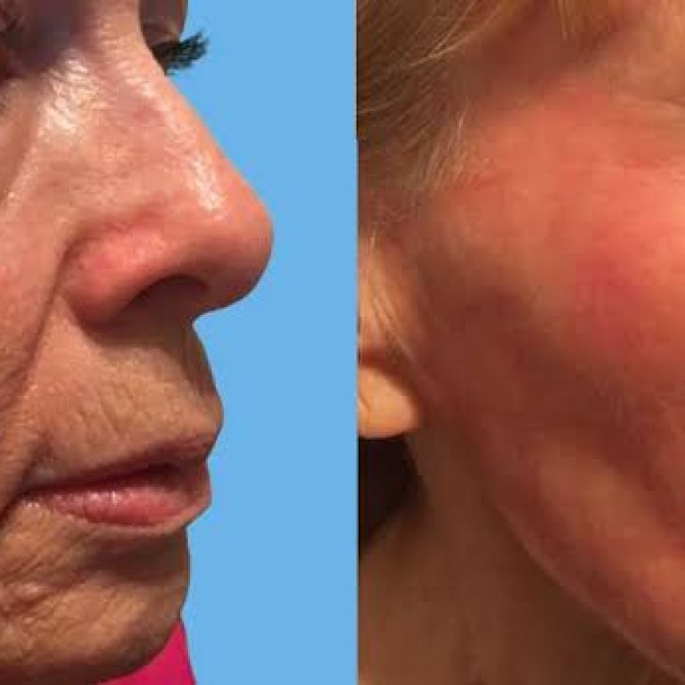 Explore our complete guide to Facelift Surgery in Florida covering treatment options, recovery time, benefits, and lasting results.