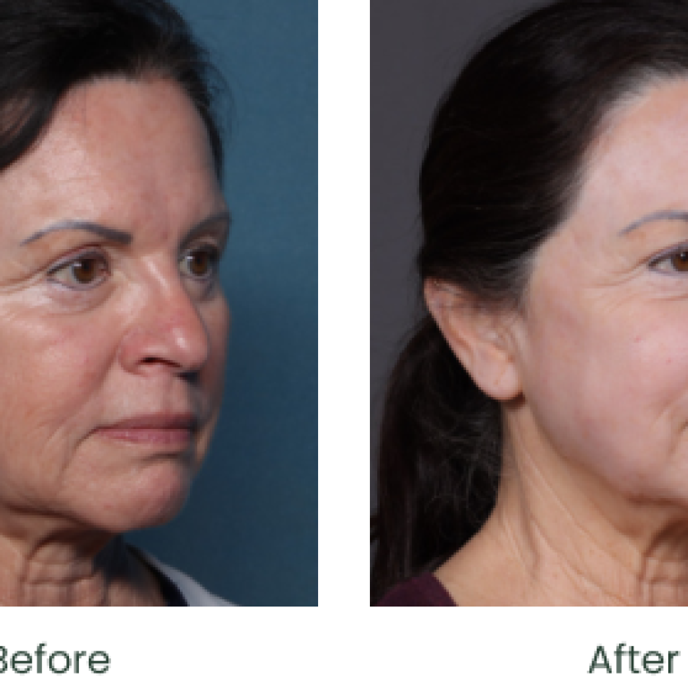 Choose a trusted Facial Rejuvenation Surgeon in Florida with confidence. Compare experience, reviews, credentials, and results today.