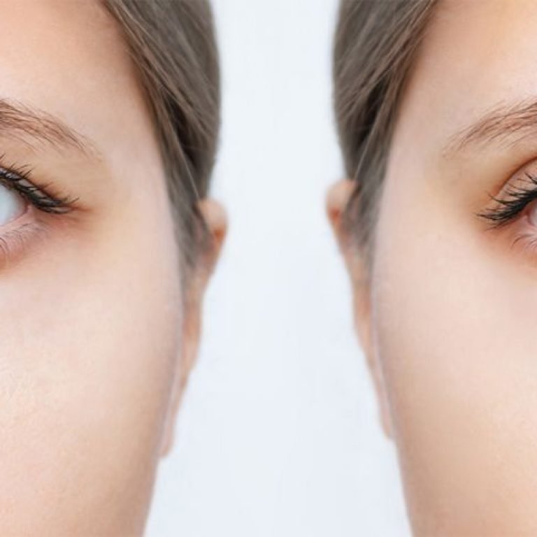 Who Is a Good Candidate for Blepharoplasty Coral Springs, FL?
