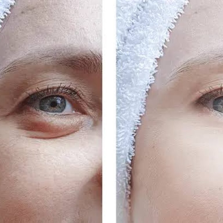 Blepharoplasty Coral Springs, FL Recovery Timeline and Tips
